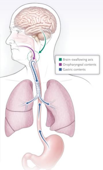 Normal swallowing compared with pulmonary aspiration.