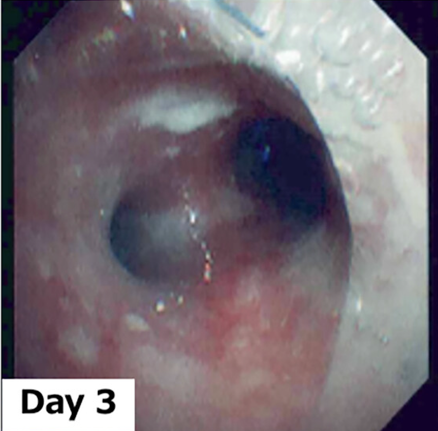 Bronchoscopic appearance of bacterial tracheitis showing inflamed tracheal mucosa and adherent purulent secretions