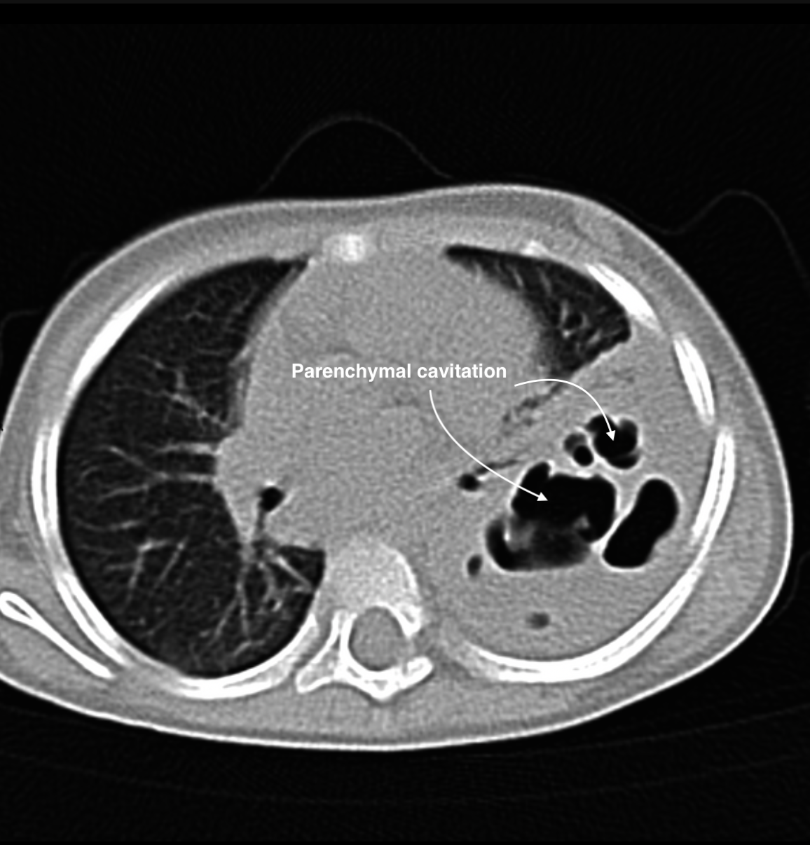 Chest CT demonstrating multiple cavitary lesions within consolidated lung.