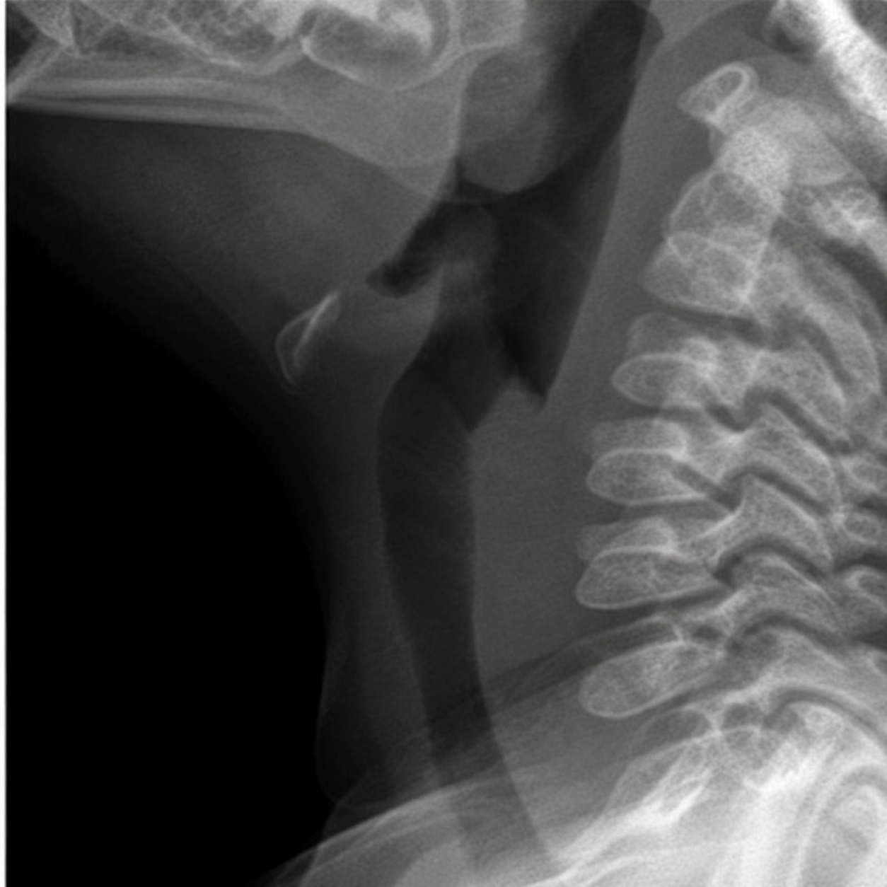 Normal pediatric lateral neck radiograph