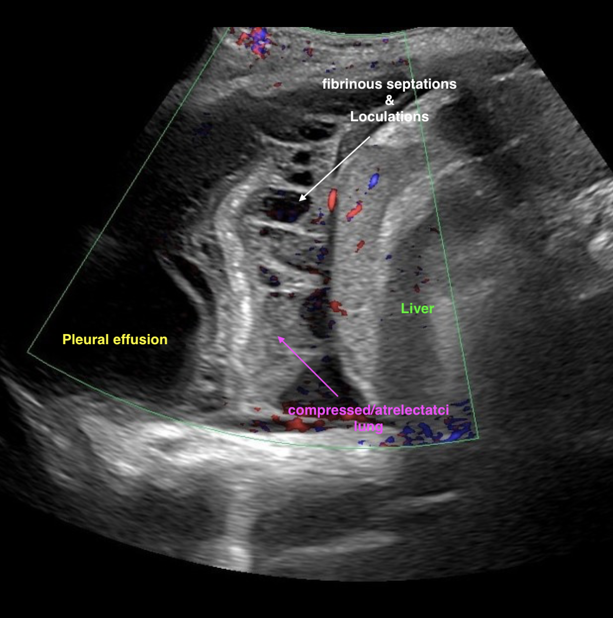 Chest ultrasound demonstrating septations and loculations within pleural fluid.