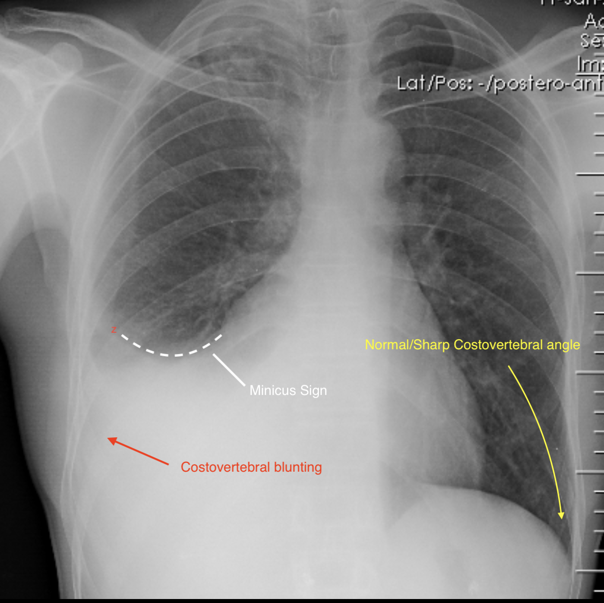 Chest radiograph demonstrating pleural effusion with blunting of the costophrenic angle and a meniscus sign.