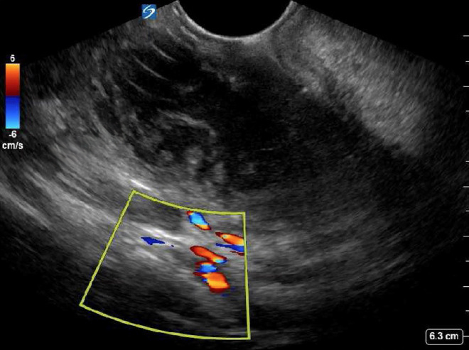 Ultrasound demonstrating a peritonsillar abscess with color Doppler imaging