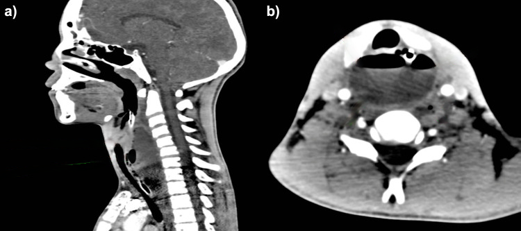 Sagittal and axial contrast-enhanced CT images demonstrating a retropharyngeal abscess