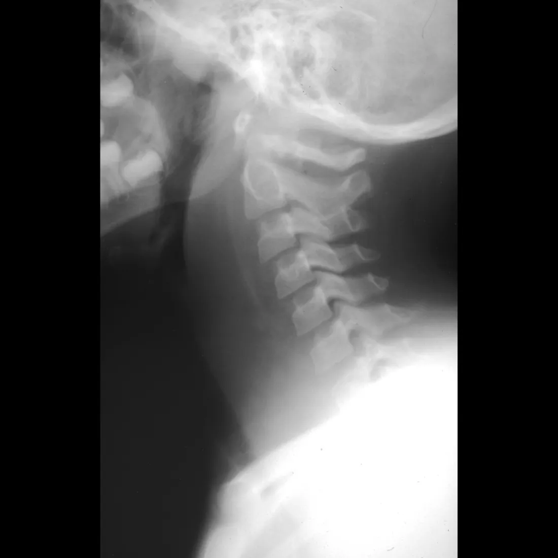 Lateral neck radiograph of a 14-month-old with retropharyngeal abscess
